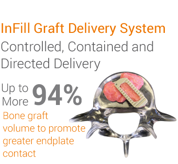 InFill Graft Delivery System. Controlled, Contained and Directed Delivery. Up to 94% More Bone graft volume to promote greater endplate contact