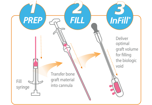 1 Prep, 2 Fill, 3 InFill. Fill syringe, Transfer bone graft material into cannula, Deliver optimal graft volume for filling the biologic void